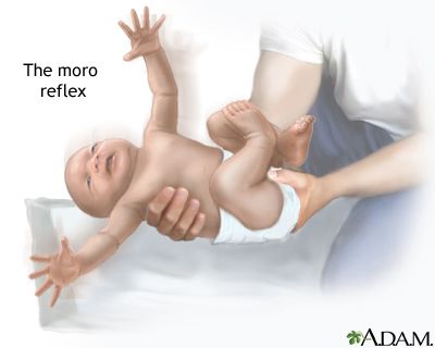 Moro reflex illustration
