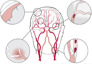 brain blood pressure